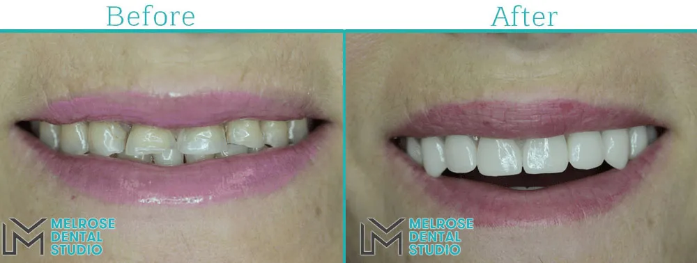 Smile makeover with porcelain veneers at Melrose Dental Studio, before and after, case 1